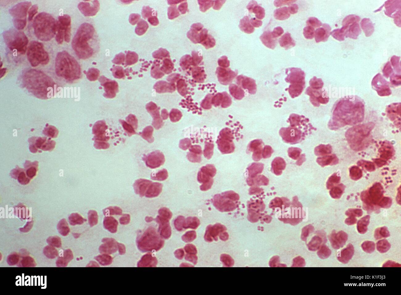 Questa è una microfotografia di un grammo macchiate di essudato uretrale campione da un maschio che ha presentato con un caso di uretriti. In questa particolare vista, ciò che si è rivelato essere numerosi intracellulare di batteri Gram-negativi Neisseria gonorrhoeae diplococci batteri erano evidenti. Gram-macchia è una tecnica istochimica utilizzato da microbiologi di differenziare i microrganismi in due grandi gruppi che di Gram-negativi, o batteri Gram-positivi. I batteri Gram-positivi la macchia scura di viola-blu, per il cristalvioletto macchia si lega all'esterno della parete cellulare di questi organismi. D'altro canto, Gram-negativi bacteri Foto Stock