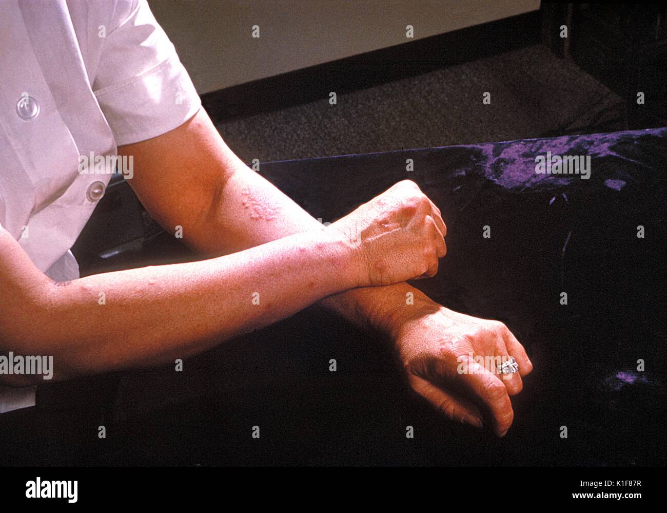 Un paziente di braccia e mani mostra la presenza di eritema nodoso. Di solito, eritema nodoso è una sequela secondaria di un altro processo di malattia o a causa di un farmaco reazione di ipersensibilità che si manifesta come gara red protuberanze sulla pelle. Immagine cortesia CDC/Margaret Renz, 1964. Foto Stock