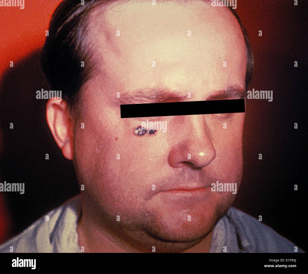 Antrace lesione della pelle sul volto di uomo immagine cutanea cortesia CDC, 1974. Foto Stock