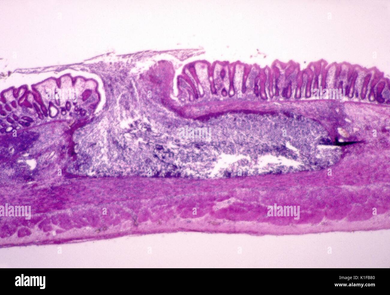 Questo fotomicrografia raffigura il istopatologiche cytoarchitectural, modifiche che riflettono un'amebiasis intestinale infezione. Nota la forma morfologica di questo tipico pallone a forma di ulcera della mucosa intestinale. Immagine cortesia CDC/Dott. Mae Melvin, 1982. Foto Stock