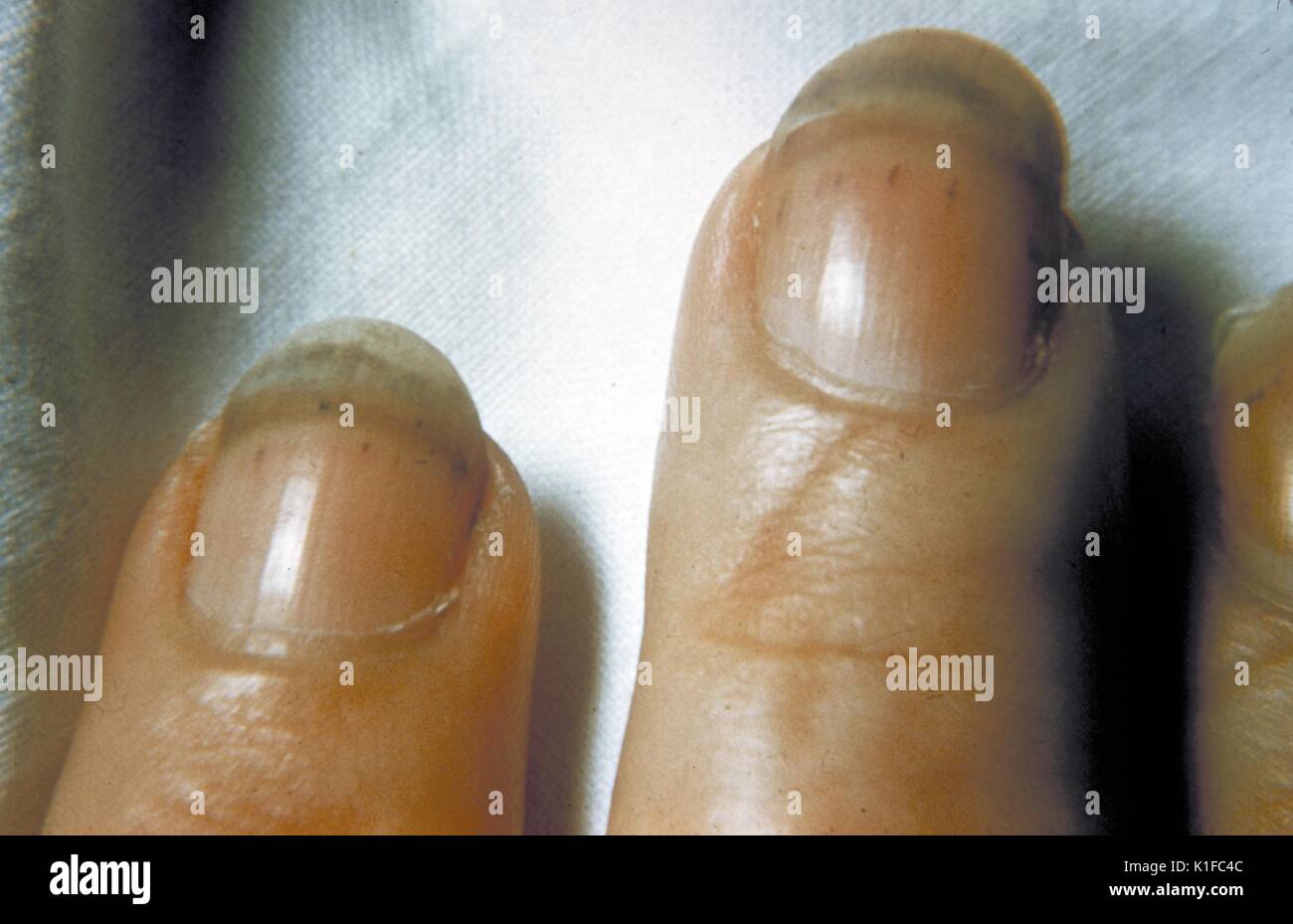 Splinter emorragie sotto le unghie in la trichinosi. Immagine cortesia CDC. 1981. Foto Stock