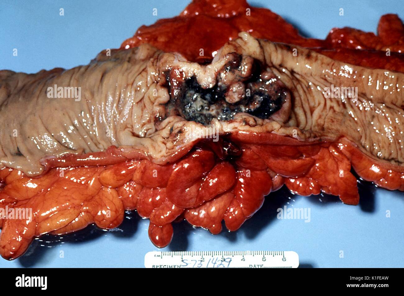 Sotto al lordo esame patologico, questo ulcerata adenocarcinomatous lesione del colon è stato rivelato. Ulcerato, endophytic adenocarcinoma del colon. Campione chirurgico. Immagine cortesia CDC/Dott. Edwin P. Ewing, Jr., 1973. Foto Stock