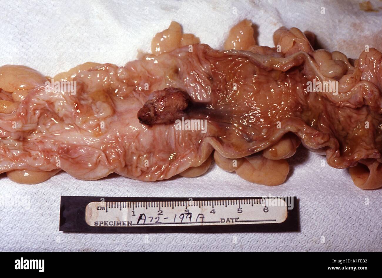 Patologia grossolana di polipo, colon, incidentali autopsia di constatazione di un polipo peduncolato durante un lordo esame patologico di un campione del colon. Immagine cortesia CDC/Dott. Edwin P. Ewing, Jr, 1972. Foto Stock