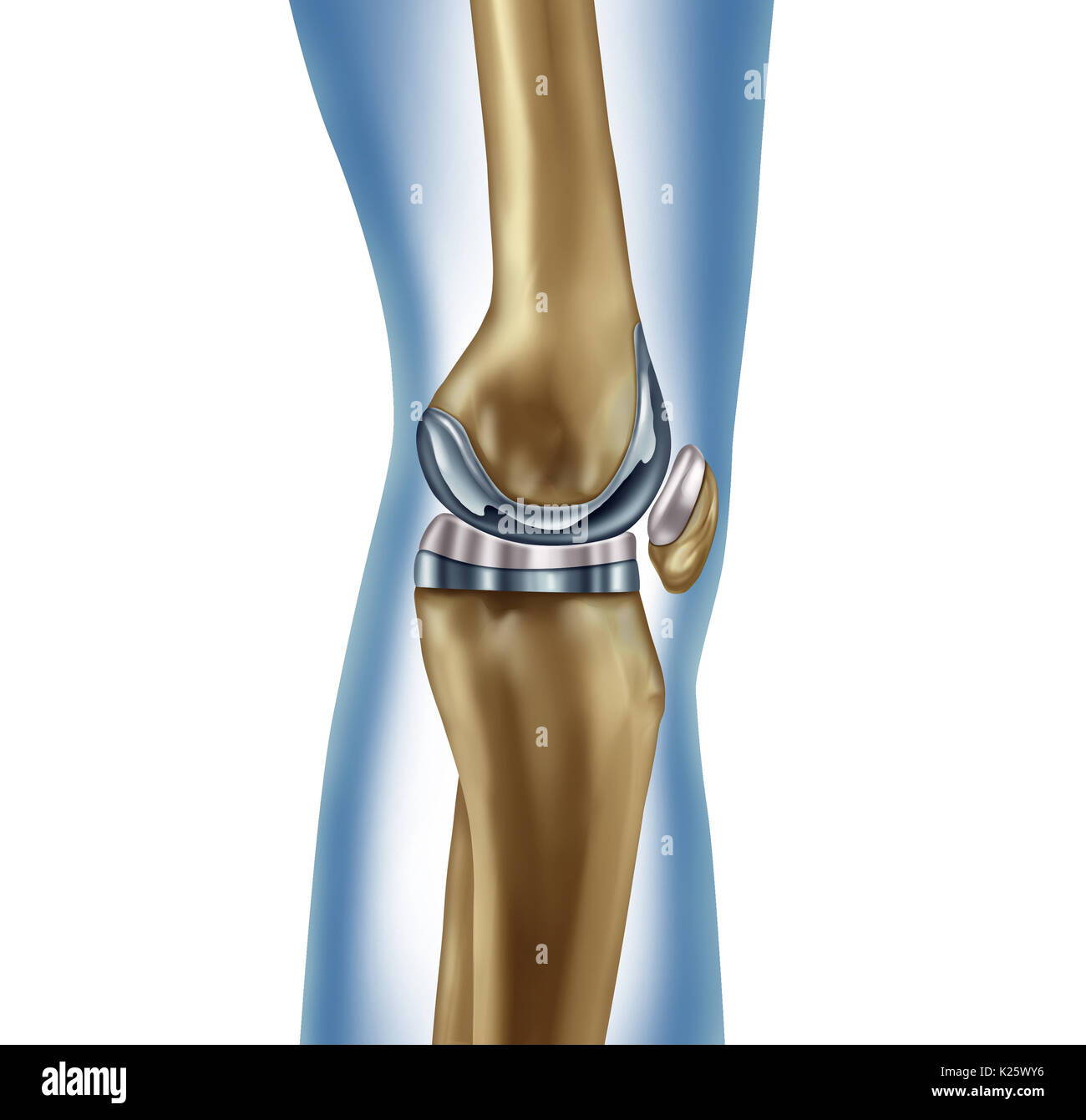 Sostituzione impianto di ginocchio concetto medico come una gamba umana anatomia dopo una chirurgia protesica come un apparato muscoloscheletrico malattia simbolo di trattamento. Foto Stock