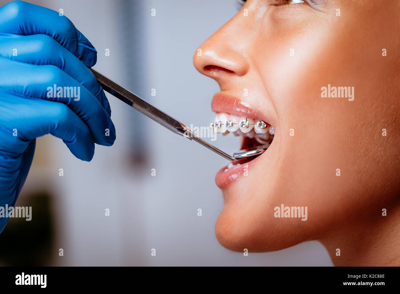 Close-up di un dentista controllo bretelle con un specchio dentale sul giovane paziente femmina. Foto Stock