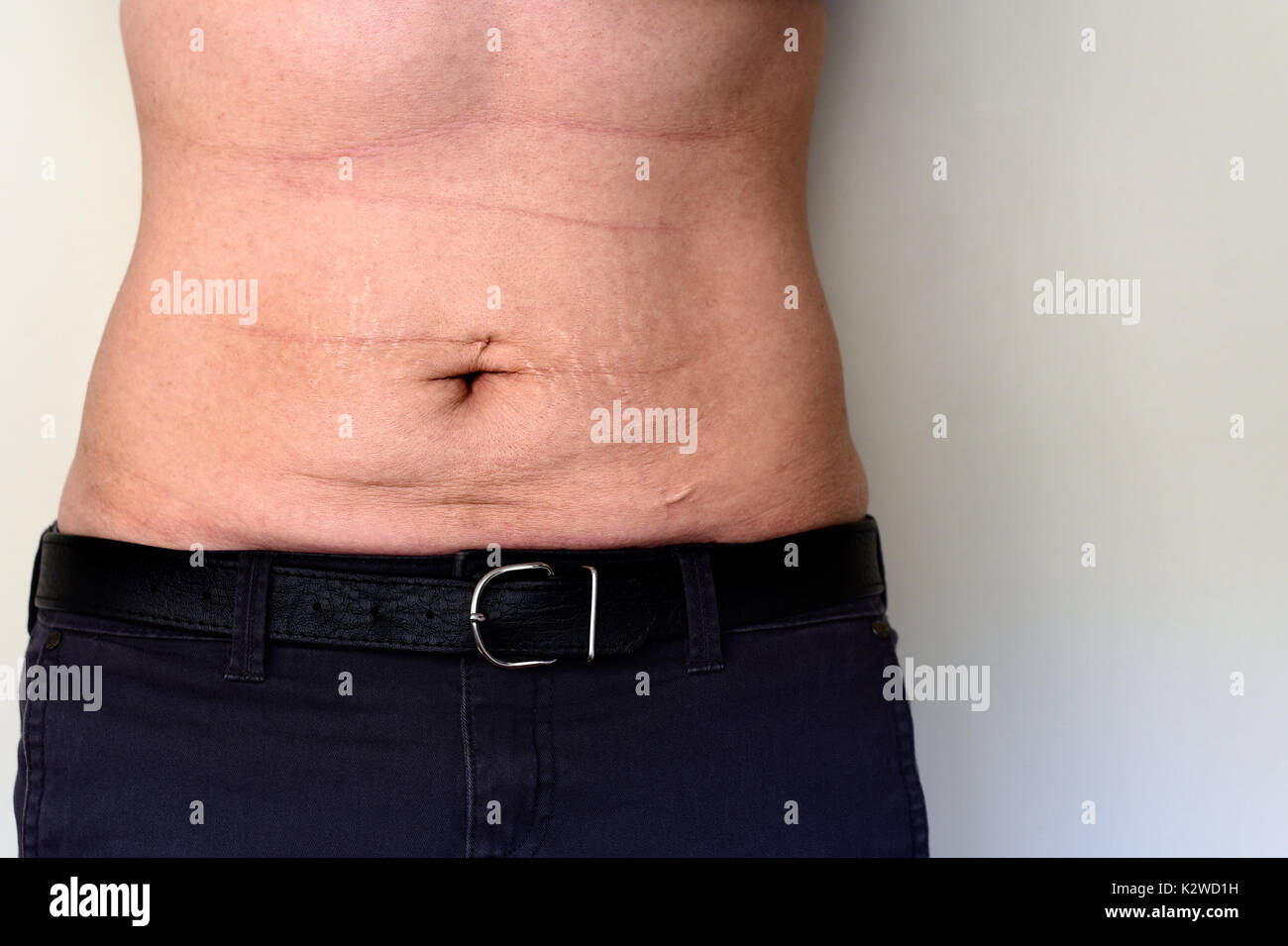 Donna ventre con smagliature e cicatrici dopo la gravidanza,perdita di peso  e piercing Foto stock - Alamy