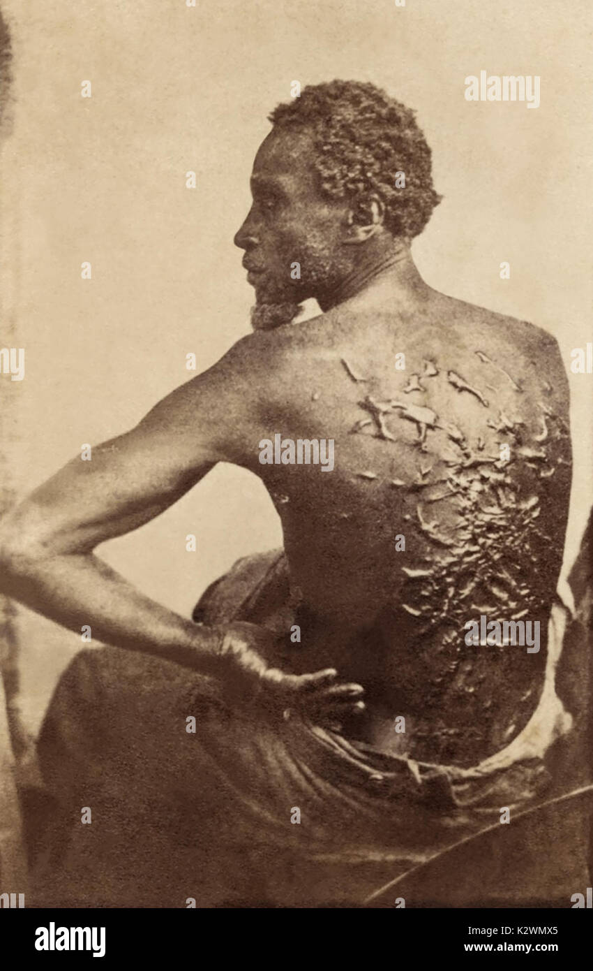 1863 foto di Gordon, un escape slave da una piantagione in Louisiana, mostrando le cicatrici sulla sua schiena da venire frustati dalla sua ex sorvegliante. Gordon (cognome) sconosciuto entrato a far parte di un reggimento di nero dell'esercito dell'Unione, noto come la Louisiana guardie nativo, dopo la sua fuga. Foto Stock
