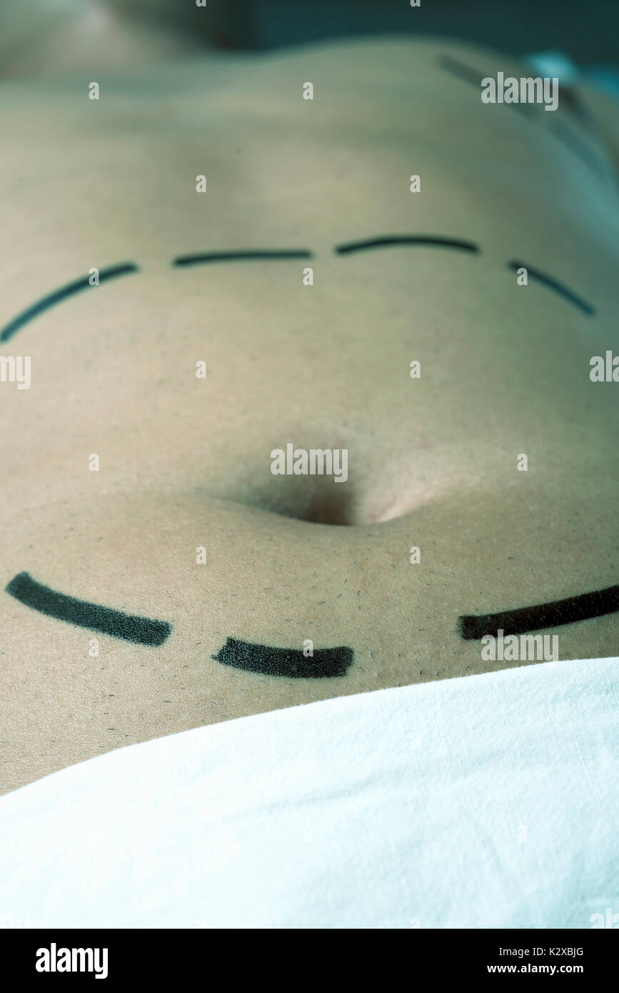 Primo piano del ventre di un giovane uomo caucasico che sta per avere un intervento di chirurgia plastica o una liposuzione con chirurgia linee marcate attorno al suo ventre Foto Stock