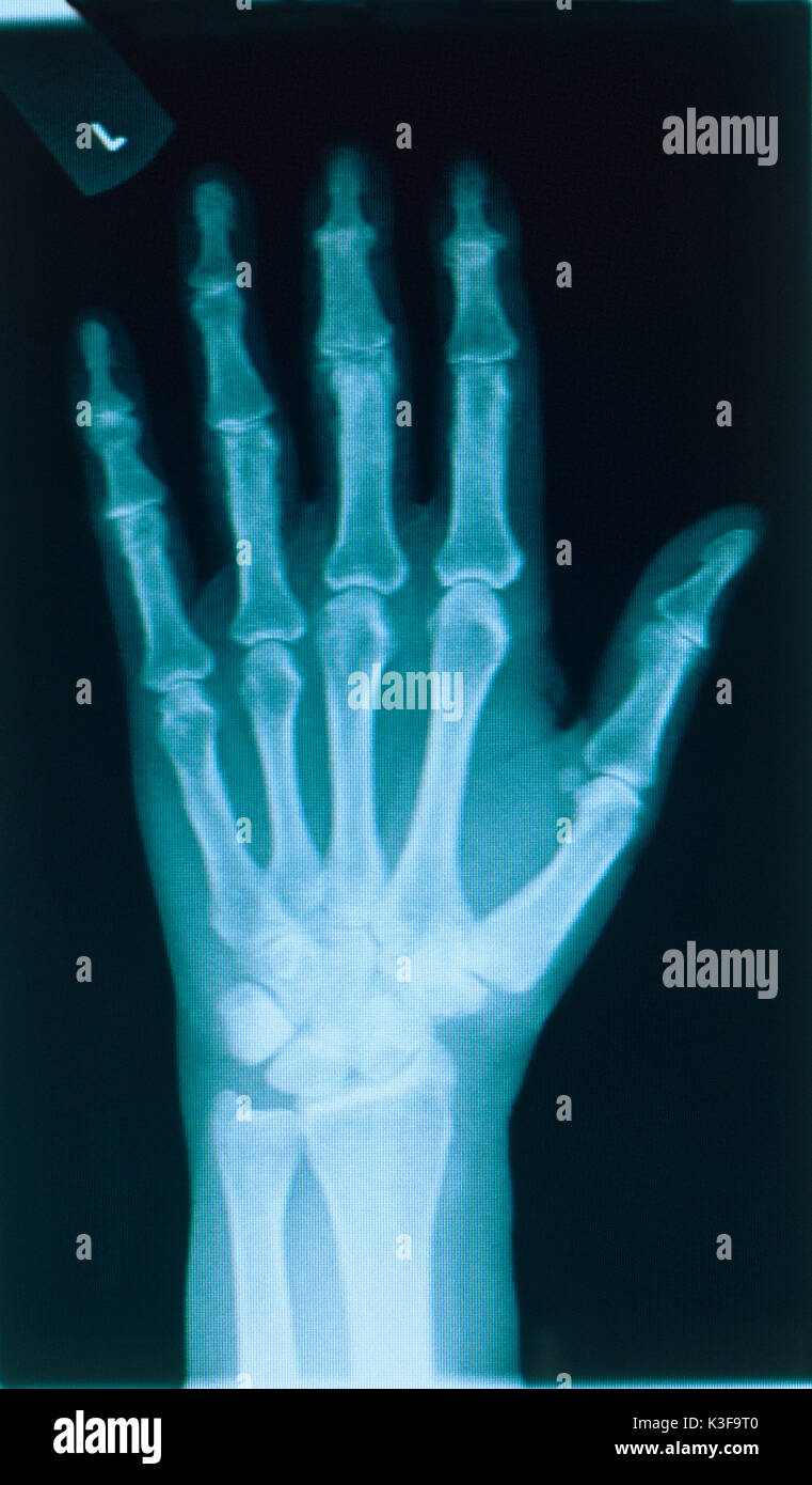X-ray immagine di una mano Foto Stock