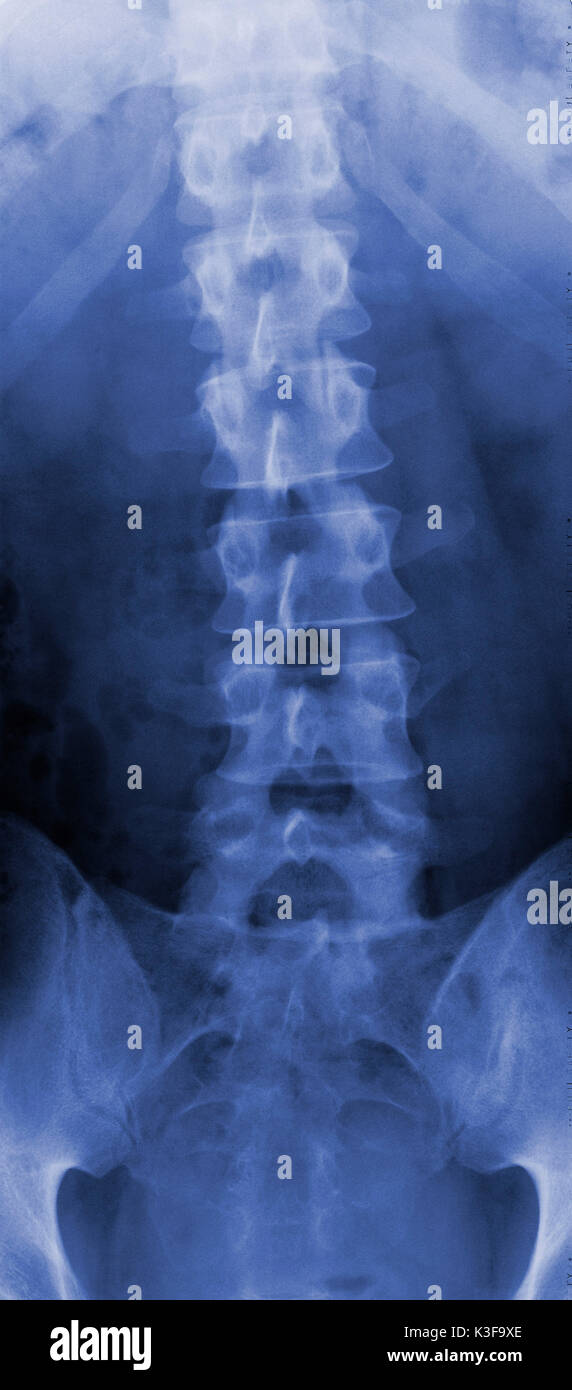 X-ray immagine della colonna vertebrale Foto Stock