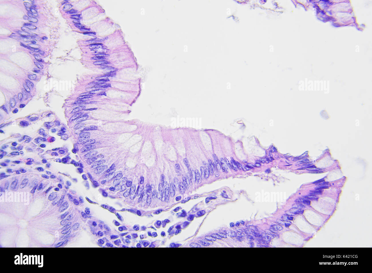 Il cancro del colon fotografia microscopica, ingrandimento x400 Foto Stock