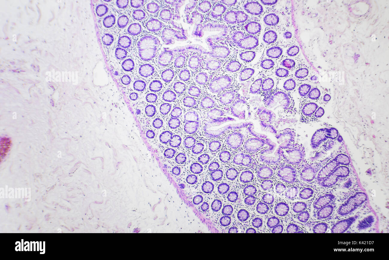 Il cancro del colon fotografia microscopica, ingrandimento x40 Foto Stock