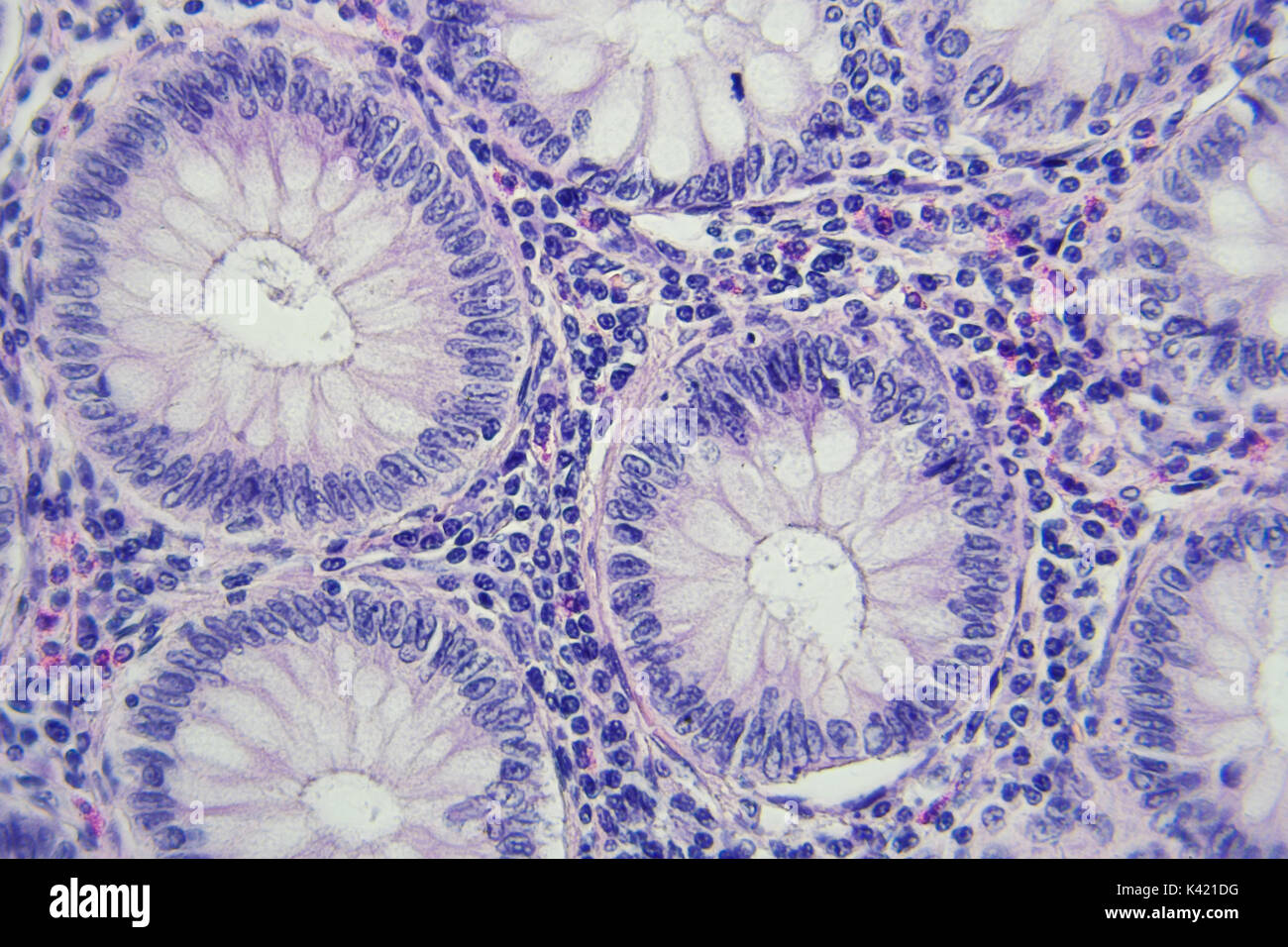 Il cancro del colon fotografia microscopica, ingrandimento x400 Foto Stock
