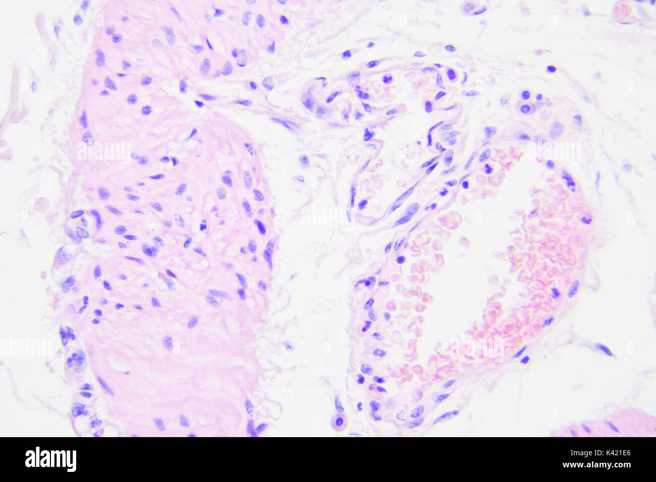 Il cancro del colon fotografia microscopica, ingrandimento x400 Foto Stock