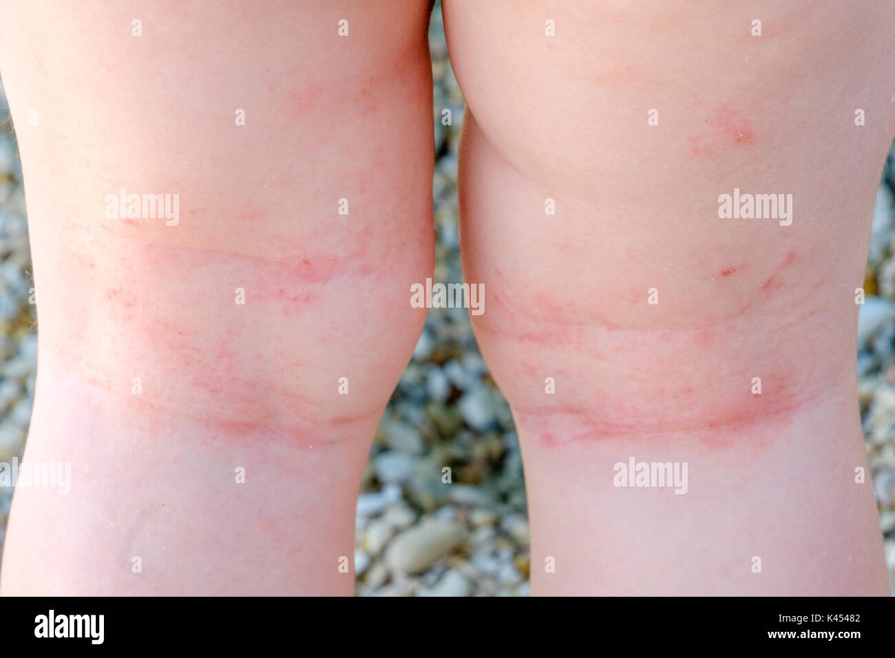 Irritazione della pelle neonato closeup dermatite atopica gambe graffi Foto Stock