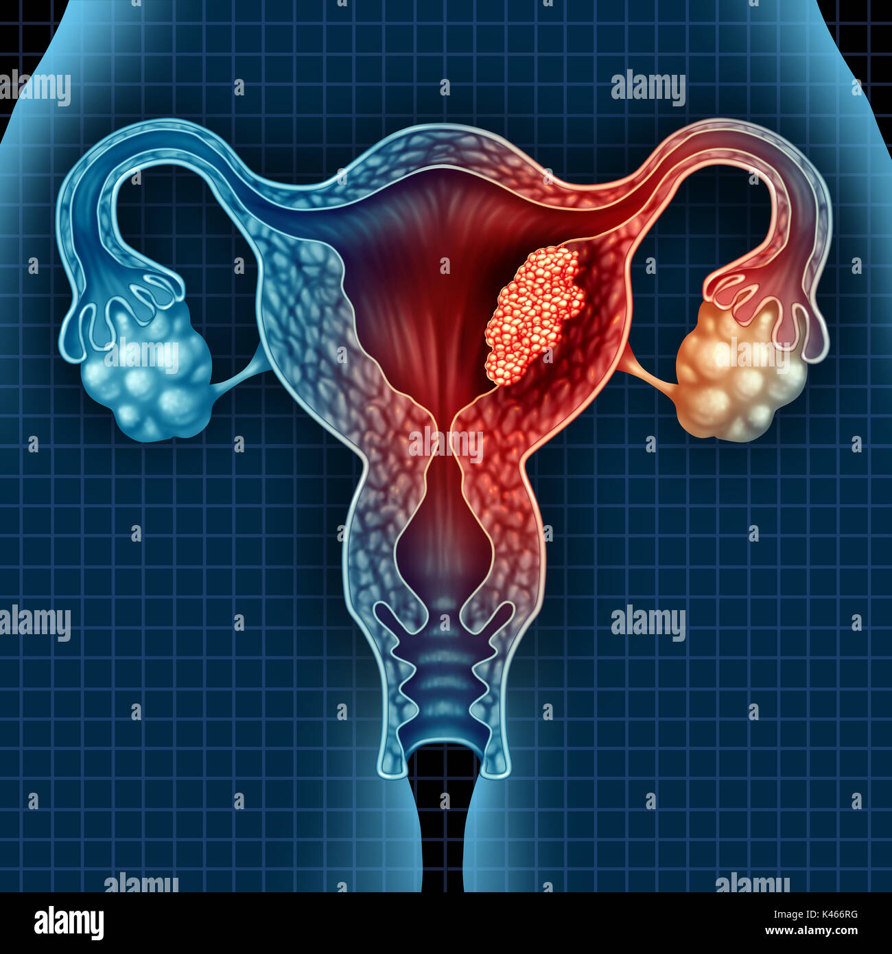 Utero cancro endometriale e tumore maligno come uterina concetto medico come pericolosi crescere le cellule in un corpo femmina di attaccare il sist riproduttiva Foto Stock