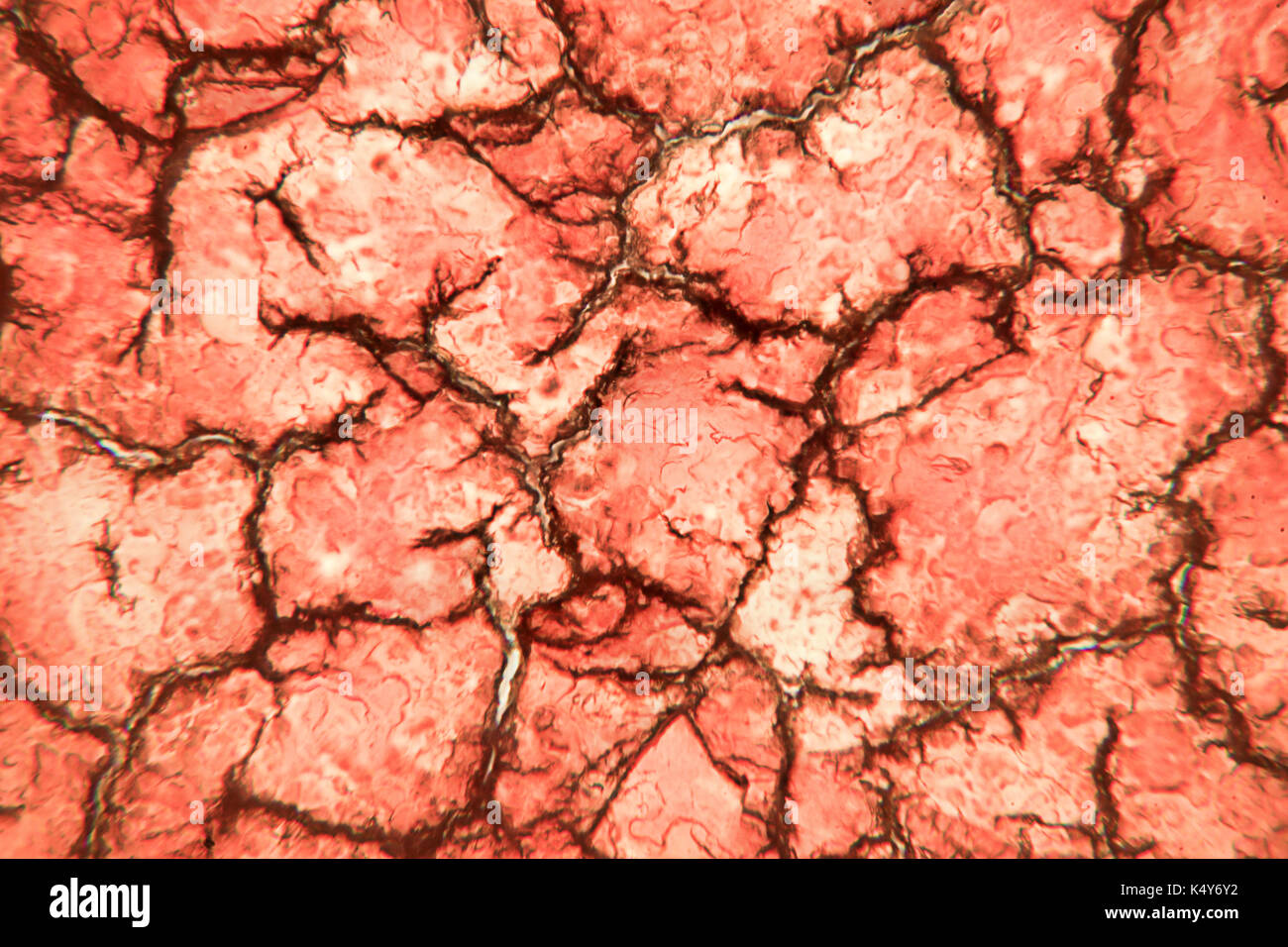 È solidificato del sangue coagulato visto su un 100x Microscopio Vista. striscio di sangue al microscopio presente di neutrofili e cellule di sangue rosse Foto Stock