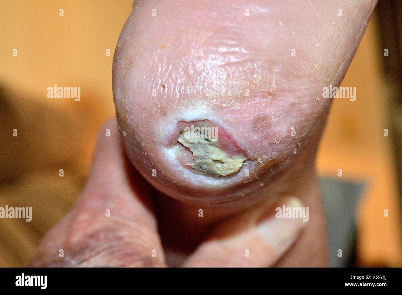 Ulcera del piede diabetico immagini e fotografie stock ad alta risoluzione  - Alamy