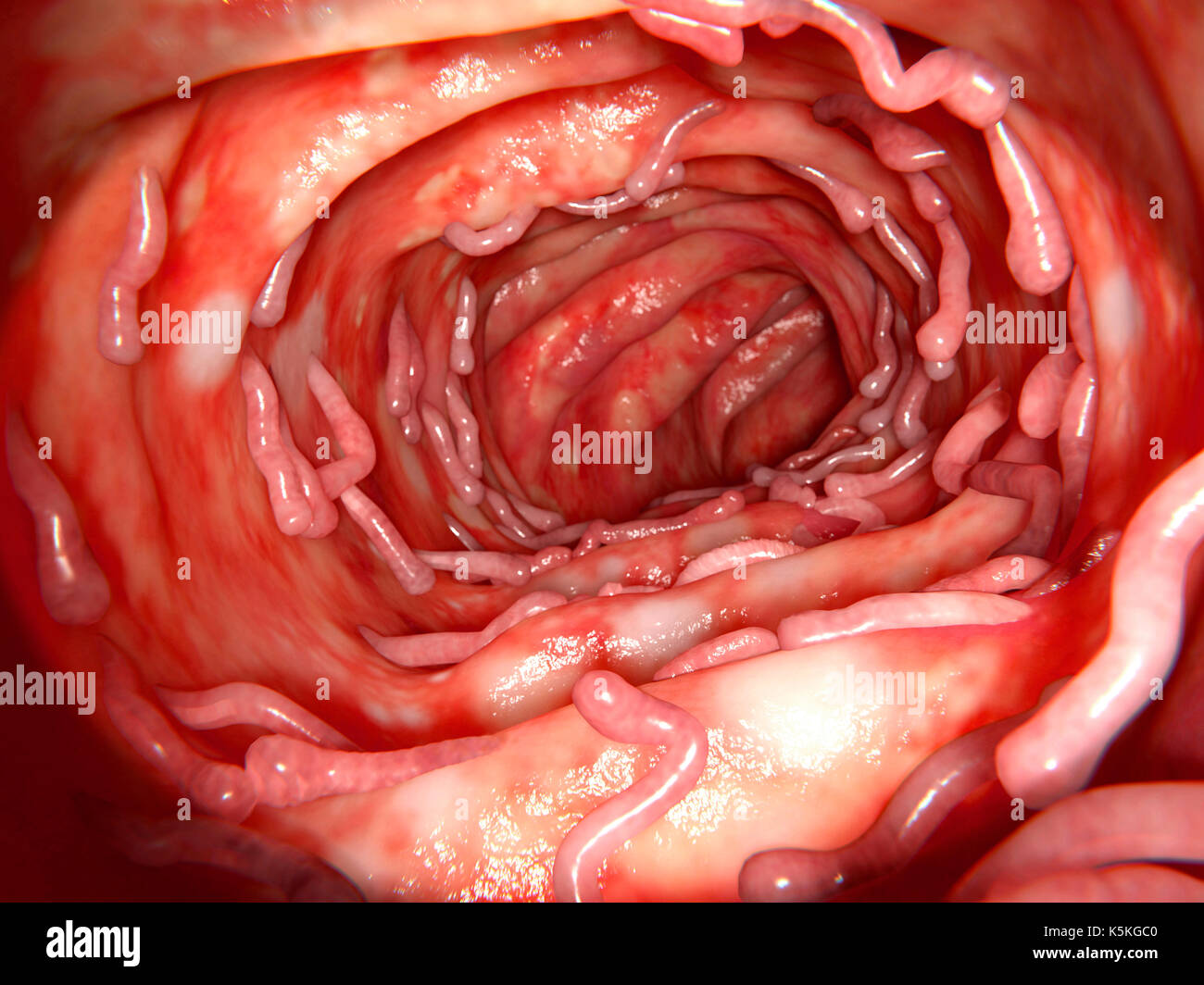 Illustrazione della colite ulcerosa e pseudopolyps nel colon. La colite ulcerosa è una malattia infiammatoria dell'intestino umano. Infiammazione ripetuta può causare il tessuto cicatriziale a forma che assomiglia ad un polipo, ed è noto come un pseudopolyp. Queste lesioni non sono neoplasic ma tessuto infiammatorio. Foto Stock