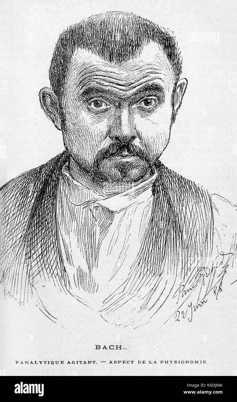 Il disegno della faccia della malattia di Parkinsons paziente mostra hypomimia Foto Stock