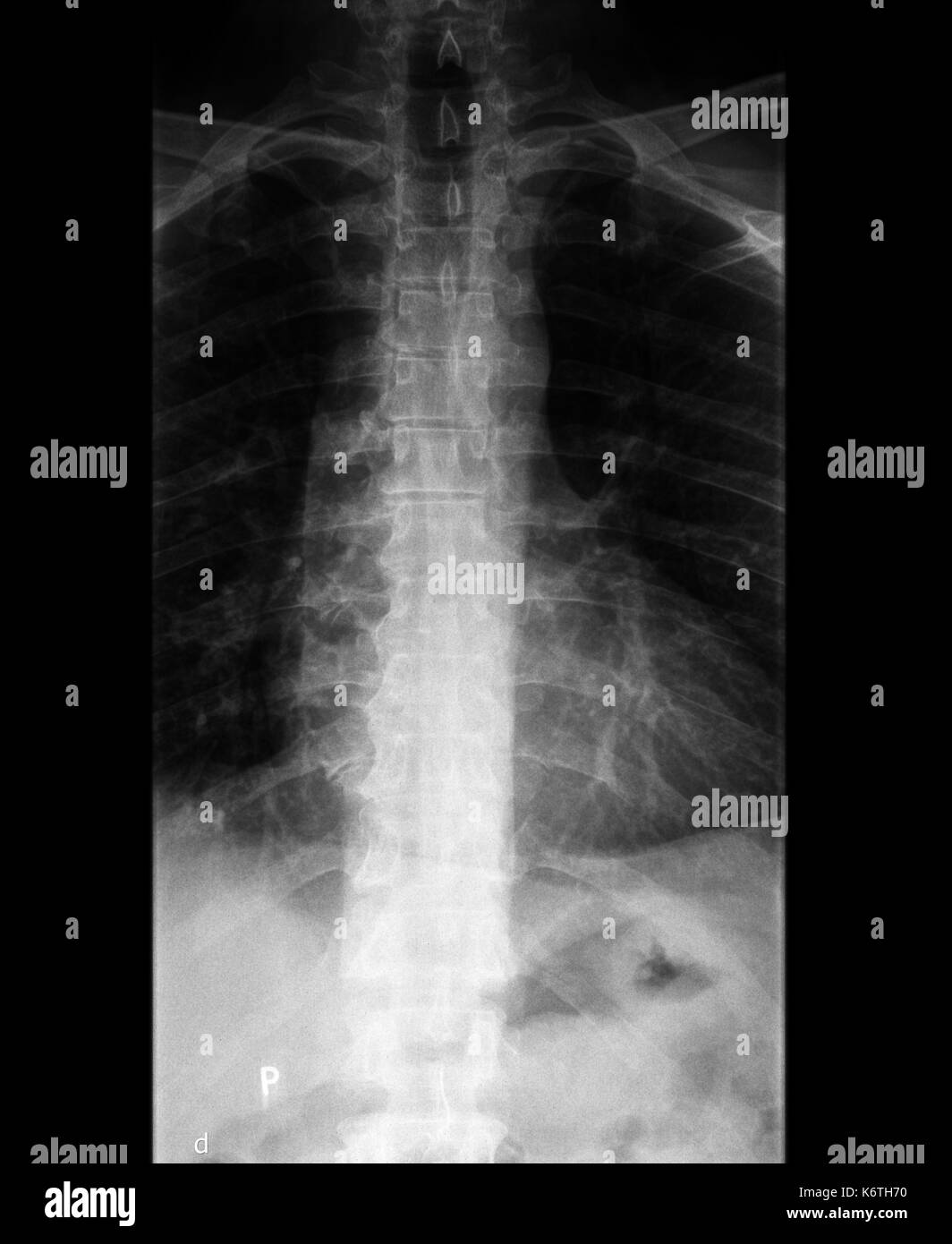 Un esame a raggi x del corpo e della colonna vertebrale e del collo Foto Stock