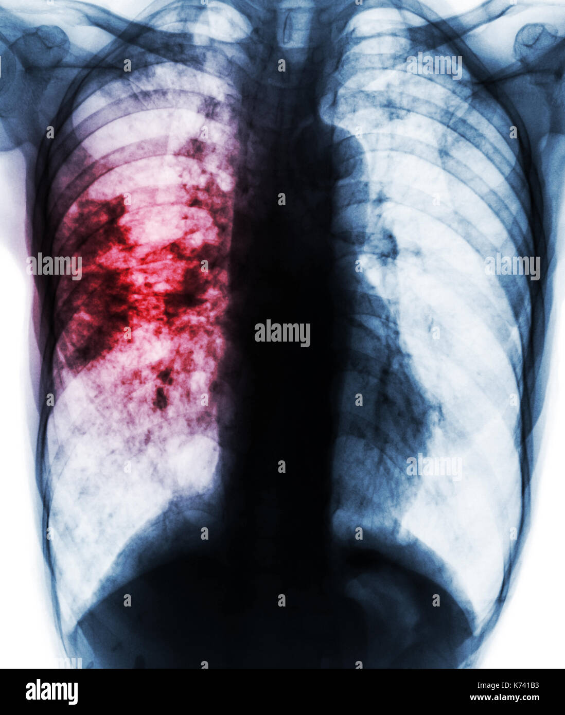 La tubercolosi polmonare . il film x-ray del torace mostra lacunose infiltrarsi al polmone destro a causa di infezione da tb . Foto Stock