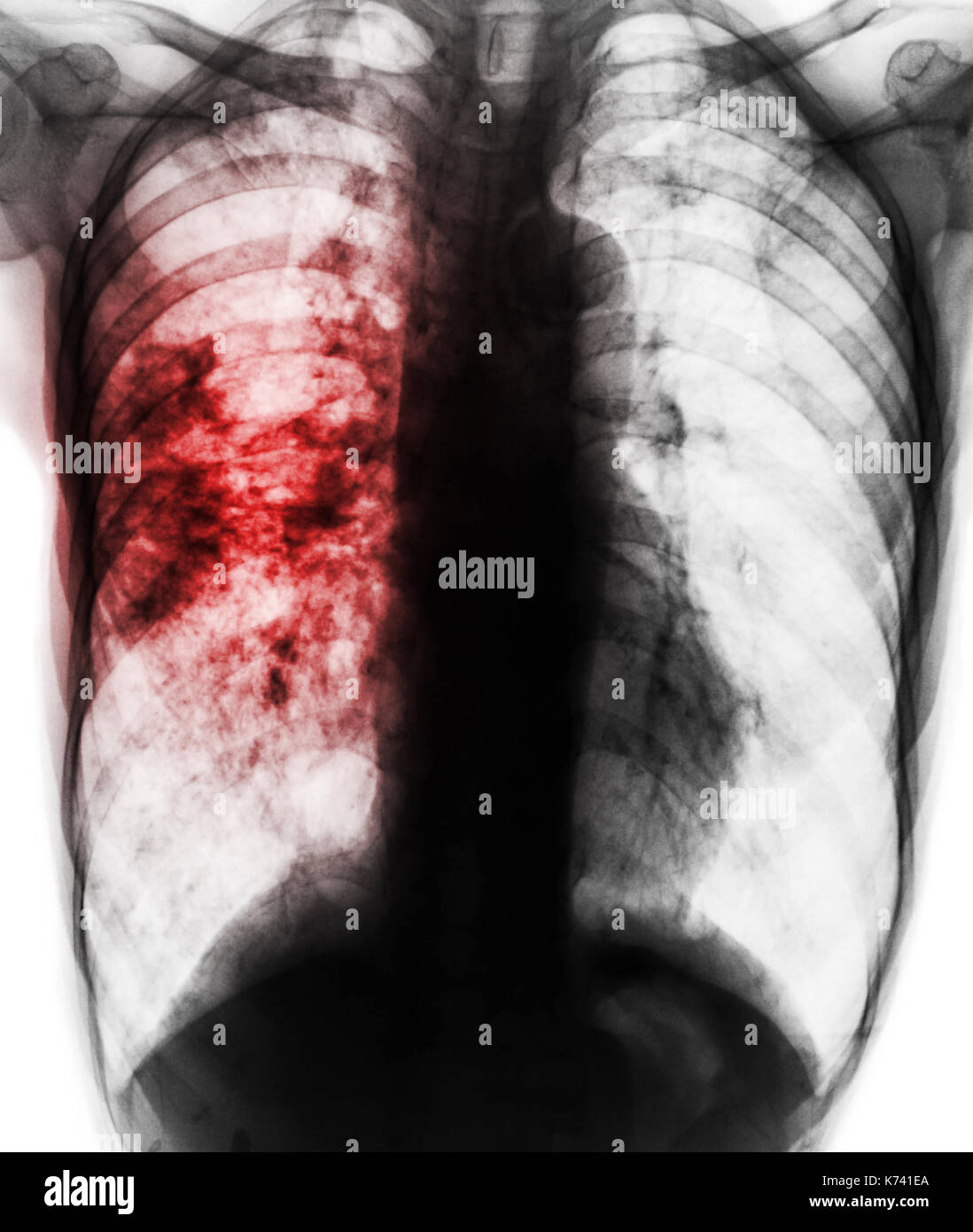 La tubercolosi polmonare . il film x-ray del torace mostra lacunose infiltrarsi al polmone destro a causa di infezione da tb . Foto Stock