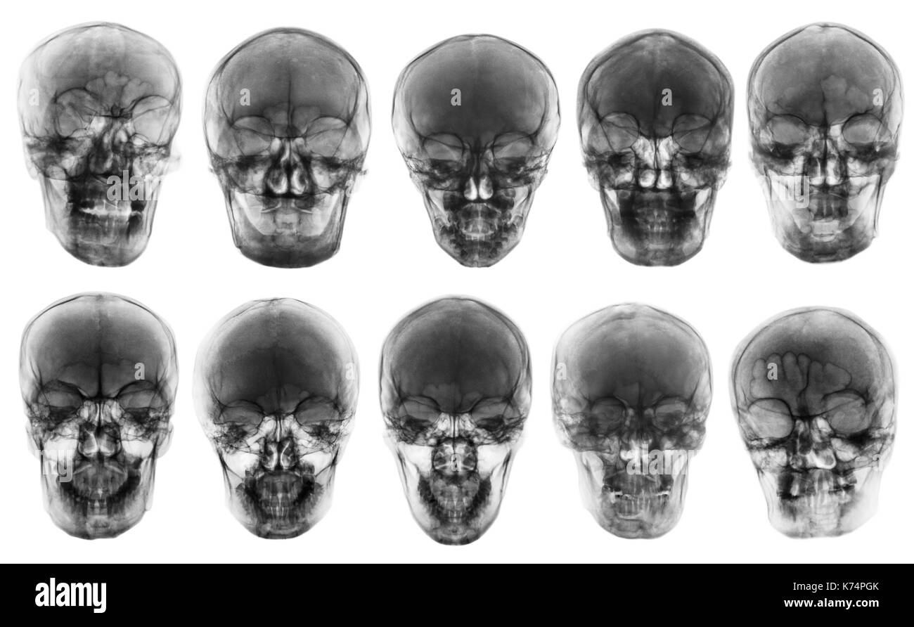 Raccolta di cranio asiatici . vista frontale . isolato sfondo . Foto Stock