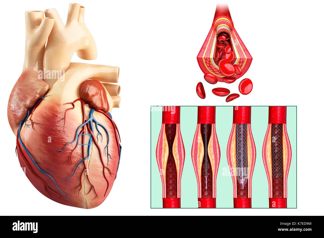 Illustrazione di angioplastica coronarica inserimento di stent. Foto Stock