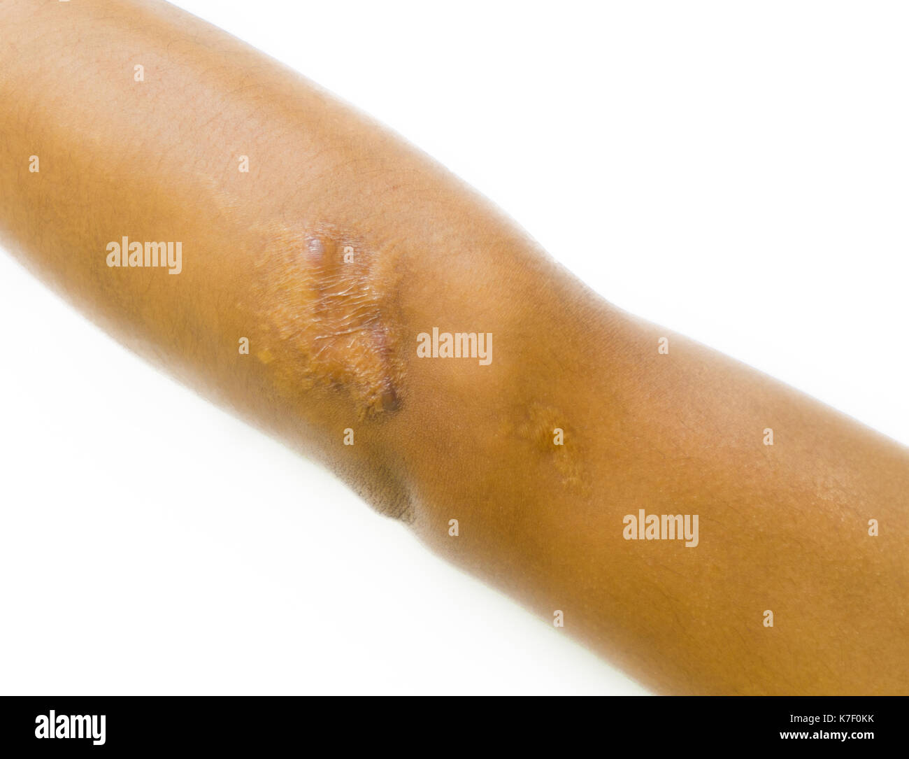 Closeup cheloide cicatrice sul gomito di uomo asiatico pelle dopo incidente in moto su sfondo bianco con copia spazio. Foto Stock