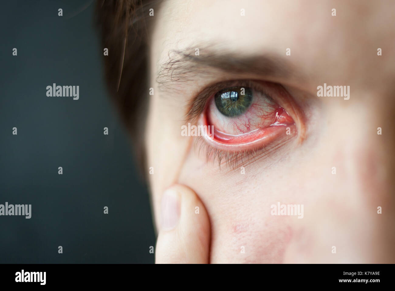 Mens red eye close-up, stanchezza, problemi con i vasi sanguigni Foto Stock