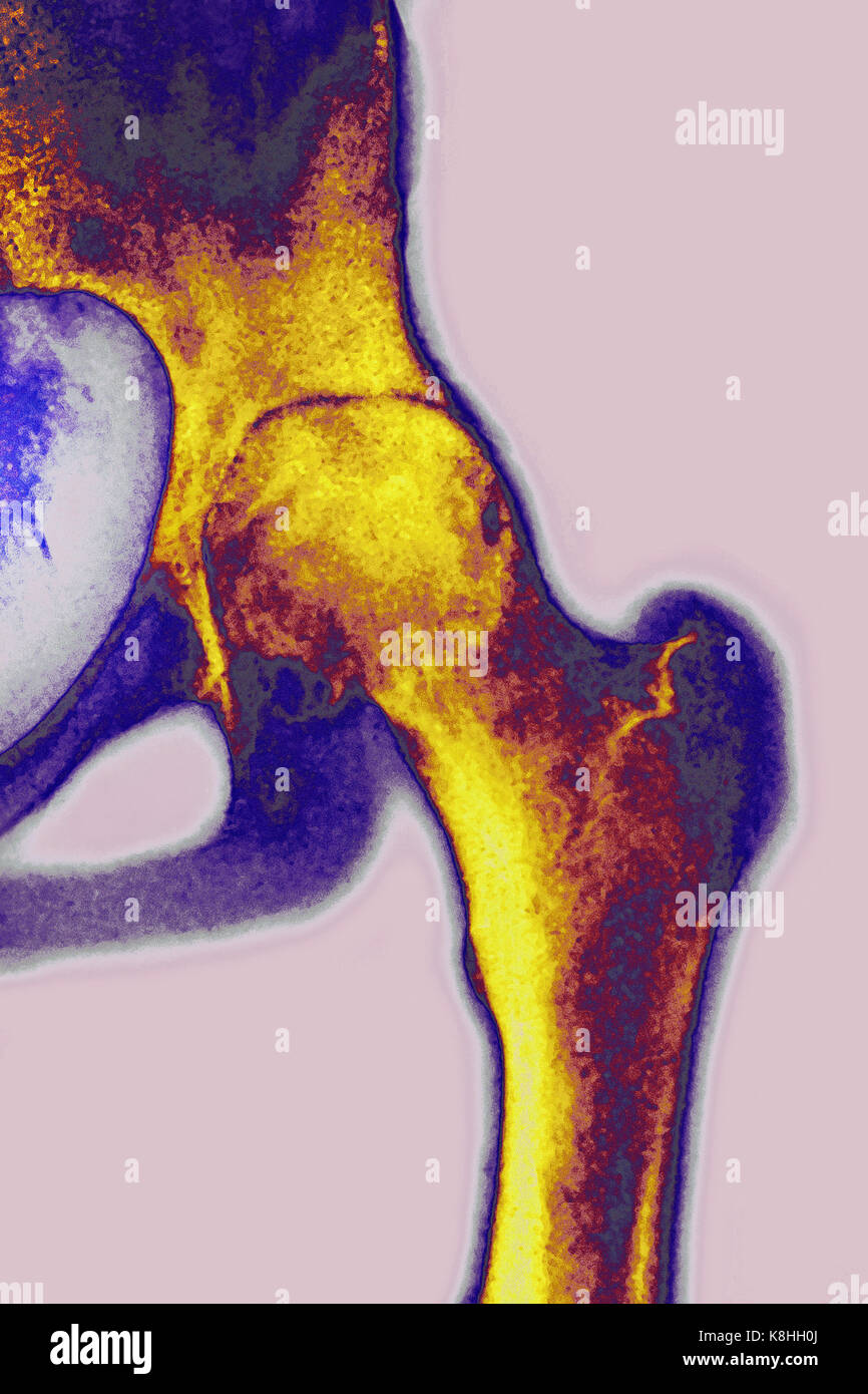 Hip osteoartrite, x-ray Foto Stock