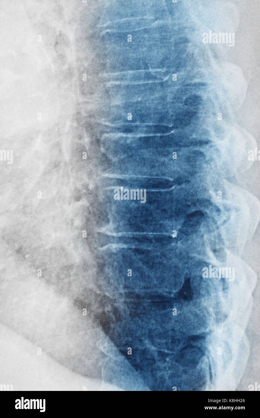Artrosi vertebrale, x-ray Foto Stock