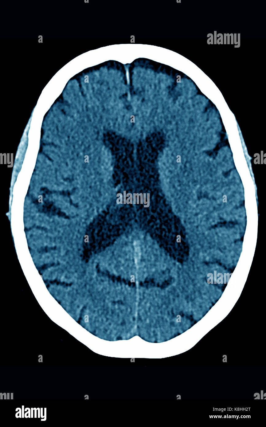 Atrofia Cerebrale La Scansione Tc Foto Immagine Stock