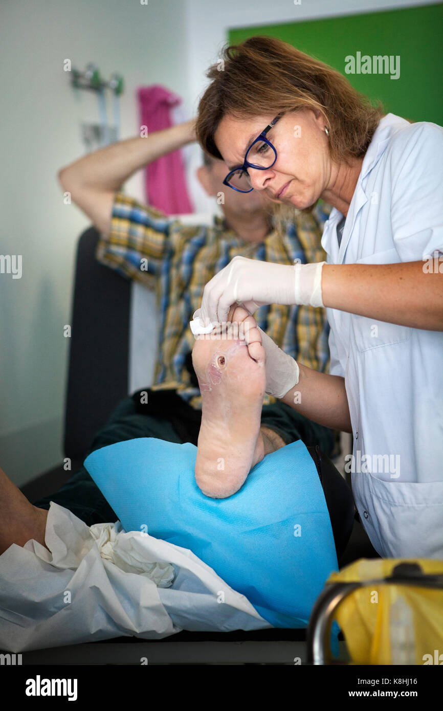 Piede diabetico Foto Stock