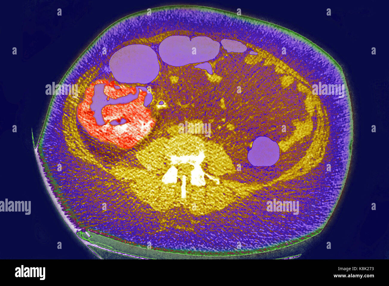 Il cancro del colon CT scan Foto Stock