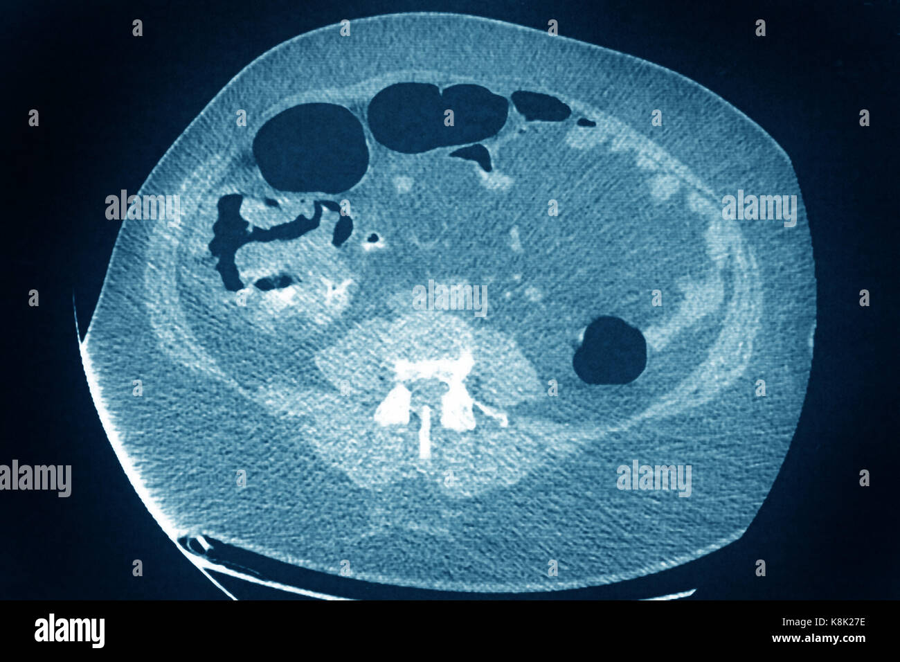 Il cancro del colon CT scan Foto Stock