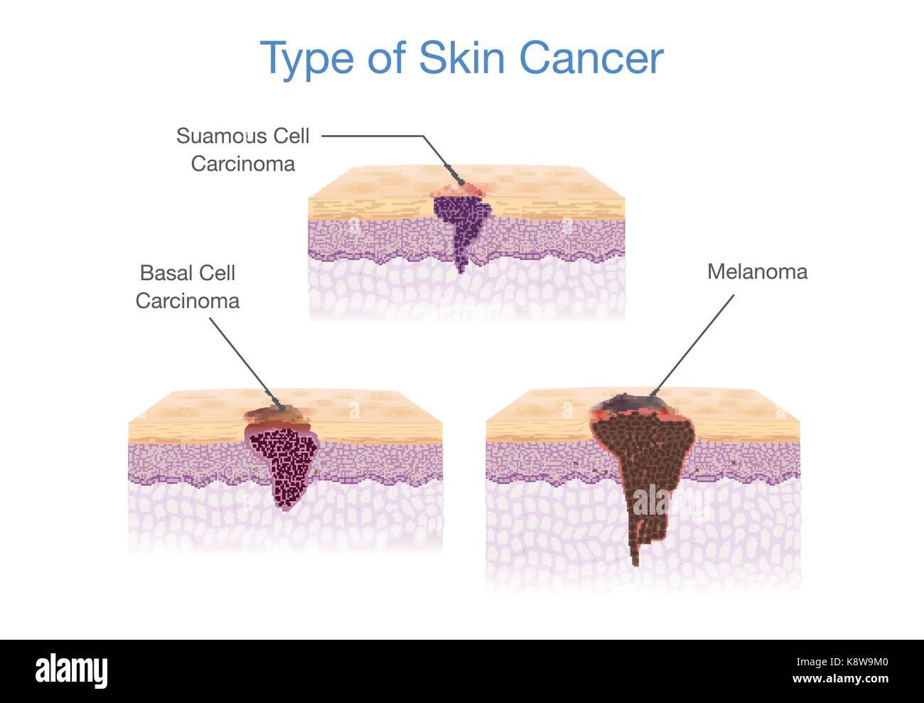 Tipo di cancro della pelle nel vettore 3d stile. Illustrazione Vettoriale