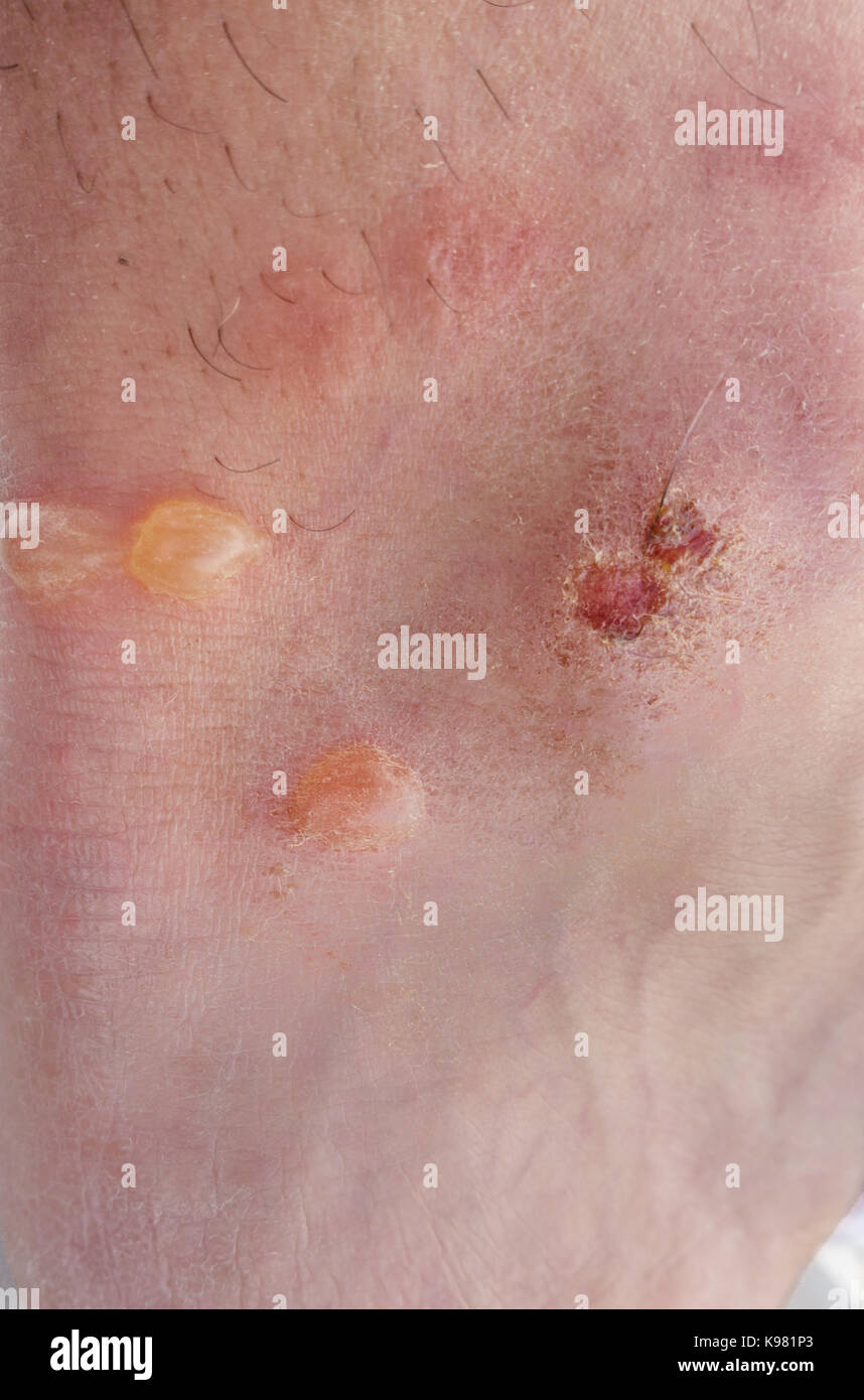 Vista dettagliata del uomo caucasico pelle con alveoli Foto Stock