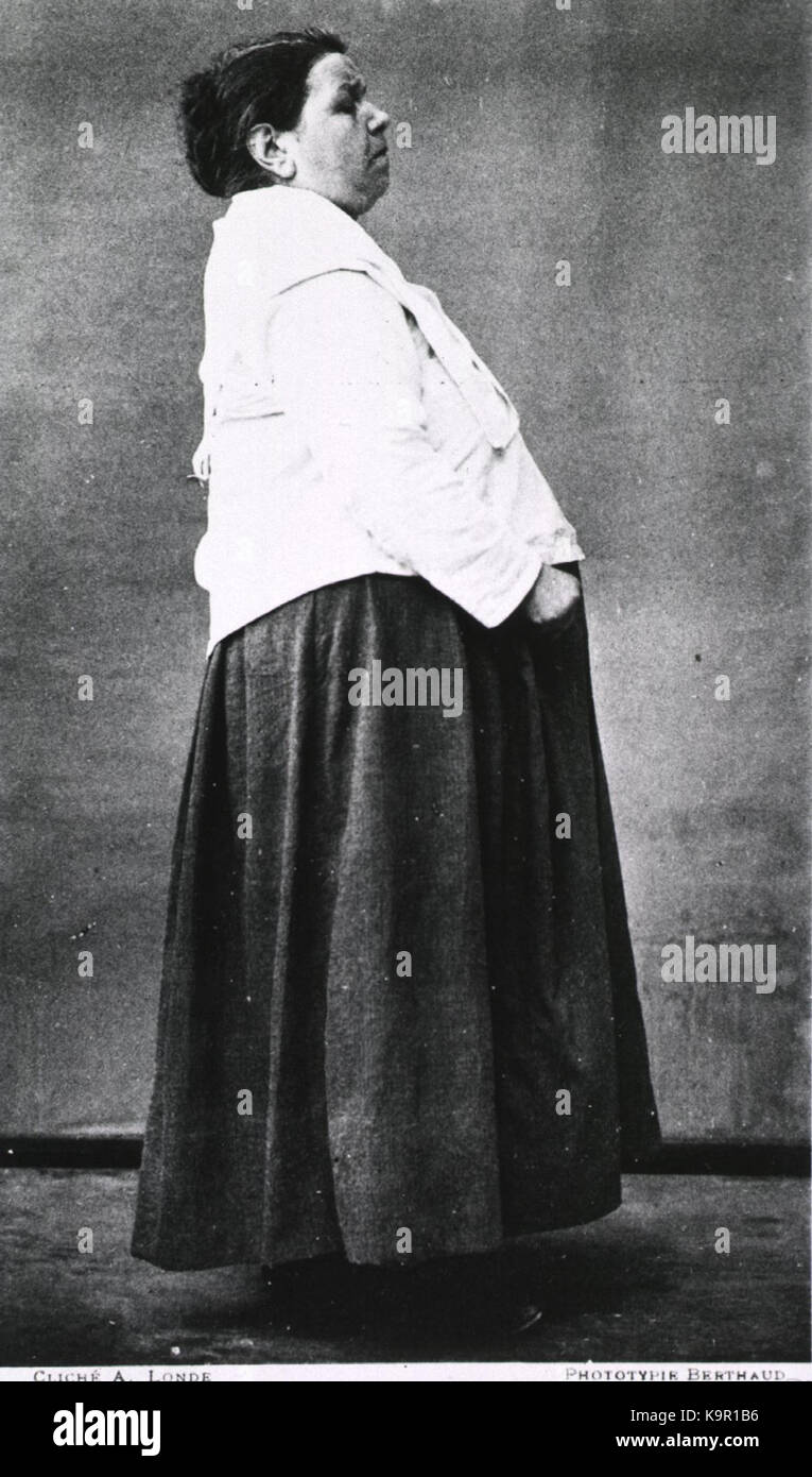 Paralisi agitans donna con il morbo di Parkinson Nouvelle Iconographie de la Salpetriere vol 2 pl29 Foto Stock