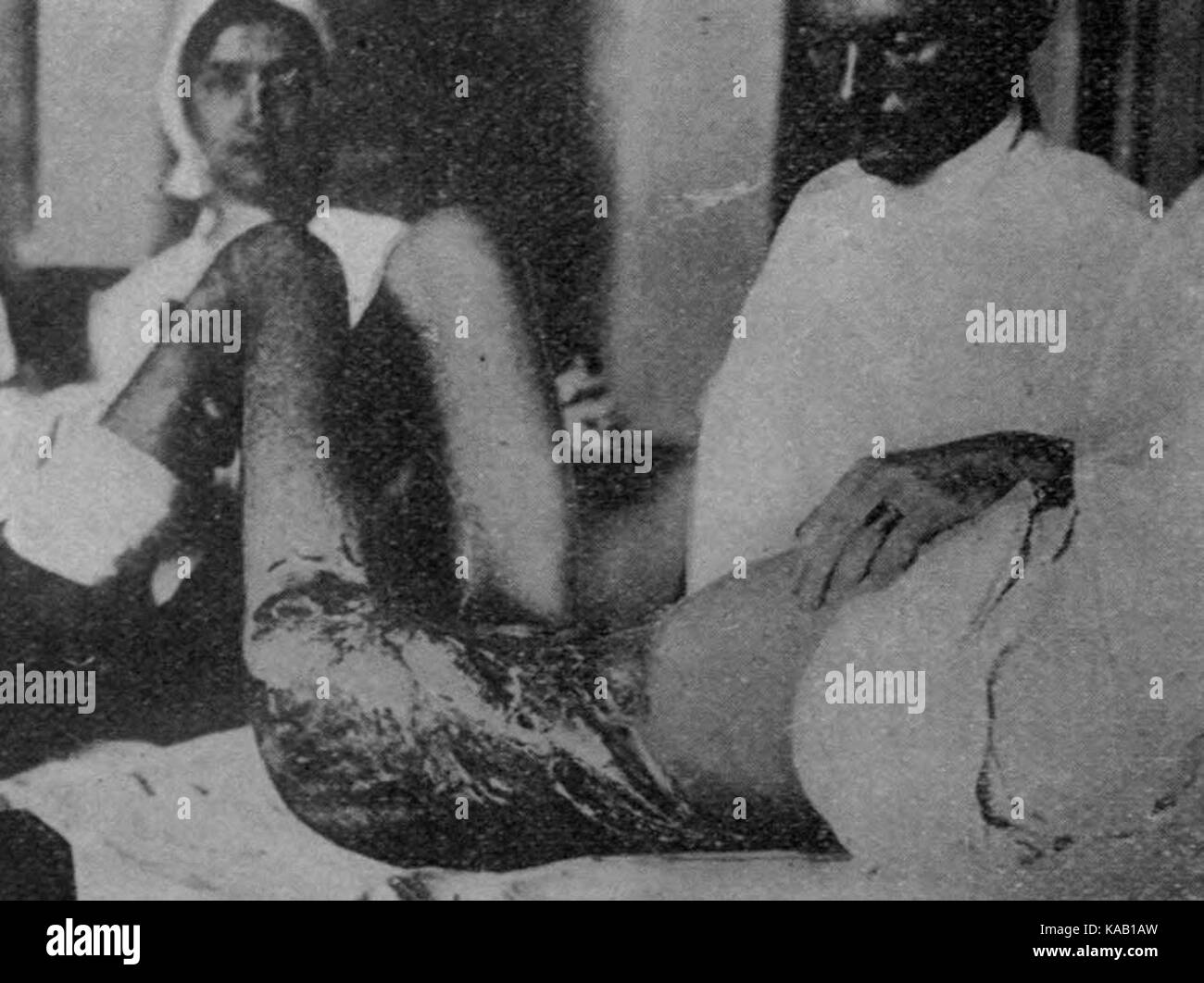 Risultato di una dum dum bullet Foto Stock