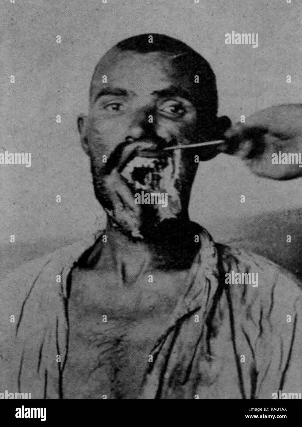 Risultato di una dum dum bullet (2) Foto Stock