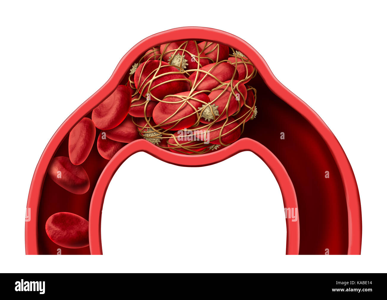 Di coagulo di sangue simbolo della malattia e trombosi medical 3d illustrazione nozione come un gruppo di cellule del sangue umano ammassate insieme da piastrine appiccicosa. Foto Stock