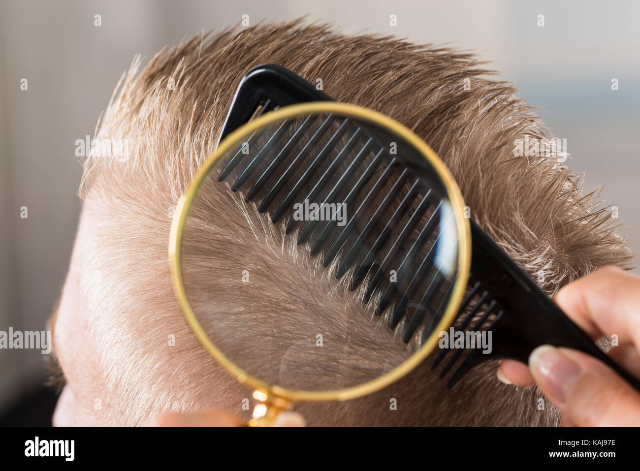 Close-up di un medico guardando al paziente i capelli attraverso la lente di ingrandimento Foto Stock