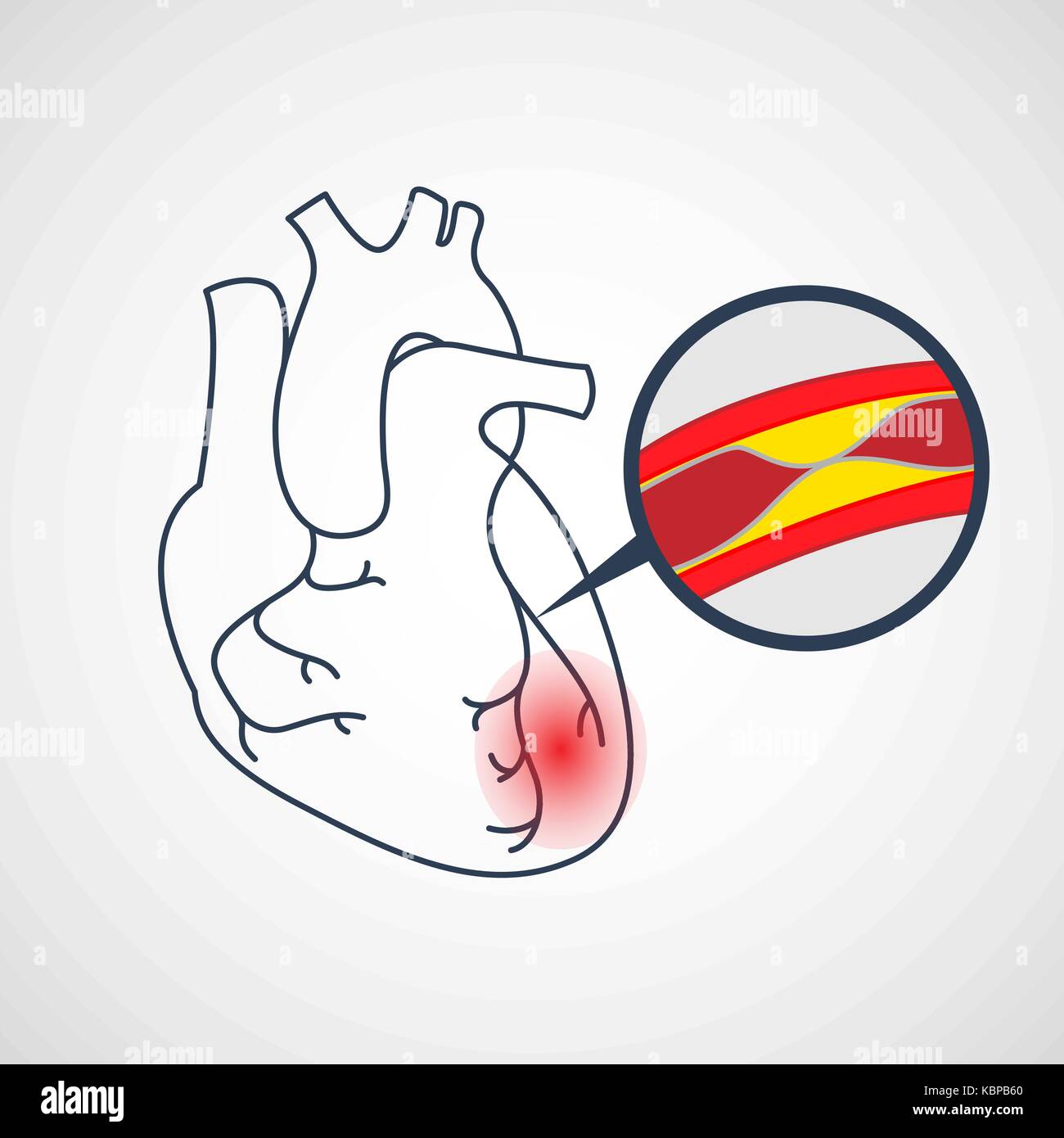 La malattia delle arterie coronarie icona vettore illustrazione Illustrazione Vettoriale