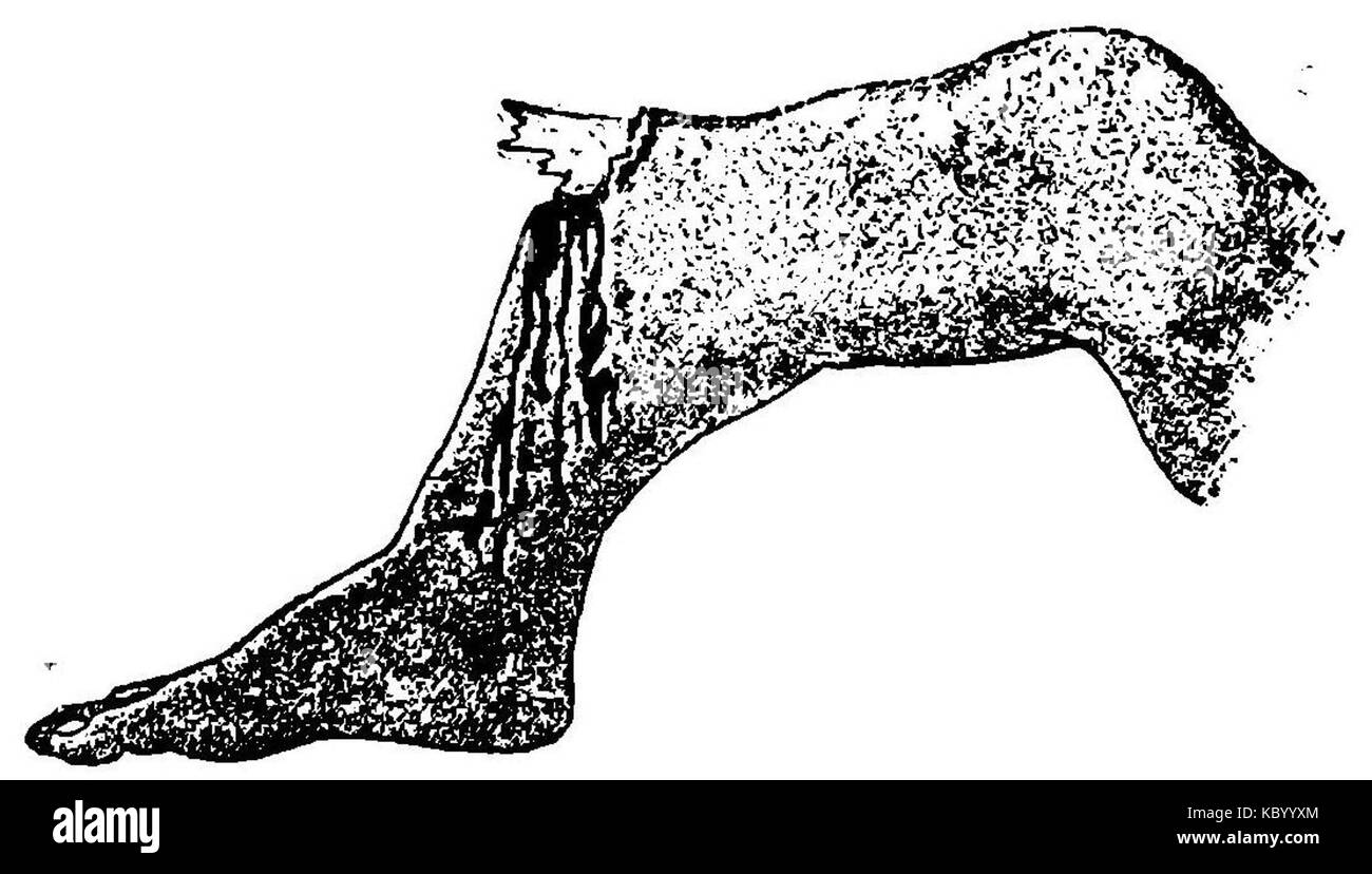 Grierson 35 expuesta Fractura de la tibia Foto Stock