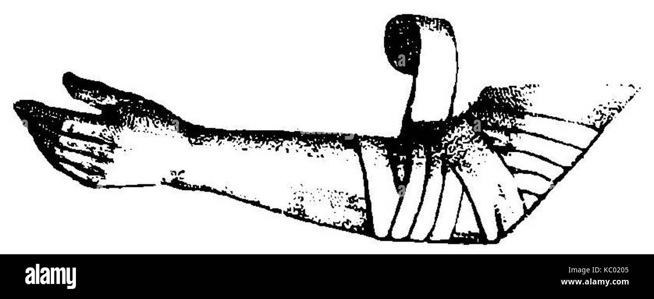 Grierson 92 Vendaje en codo Foto Stock