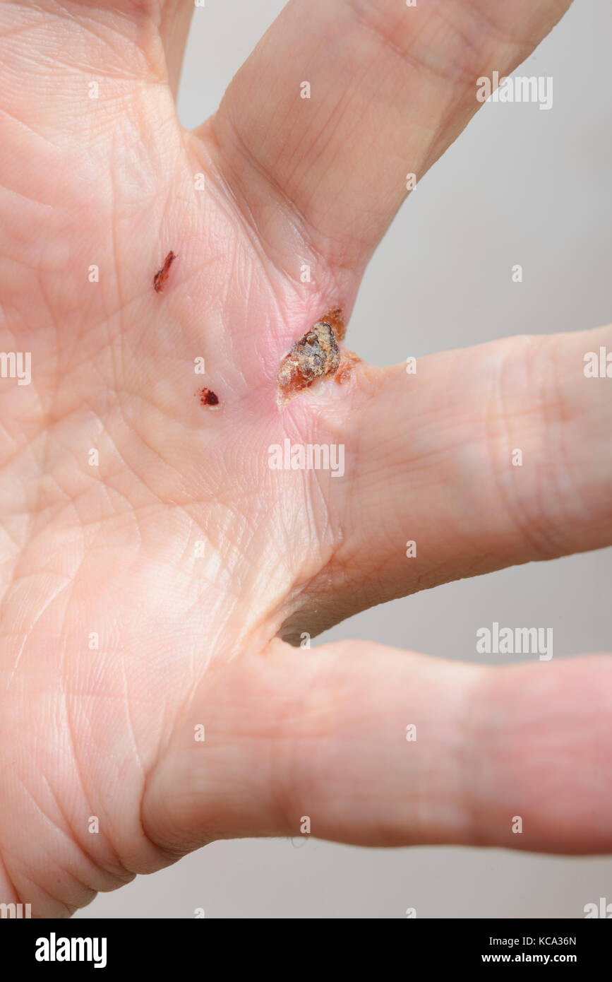 L'uomo ferito dai morsi di cane in mano la profonda ferita lasciata dal zanne tra le dita sono evidenti. Foto Stock