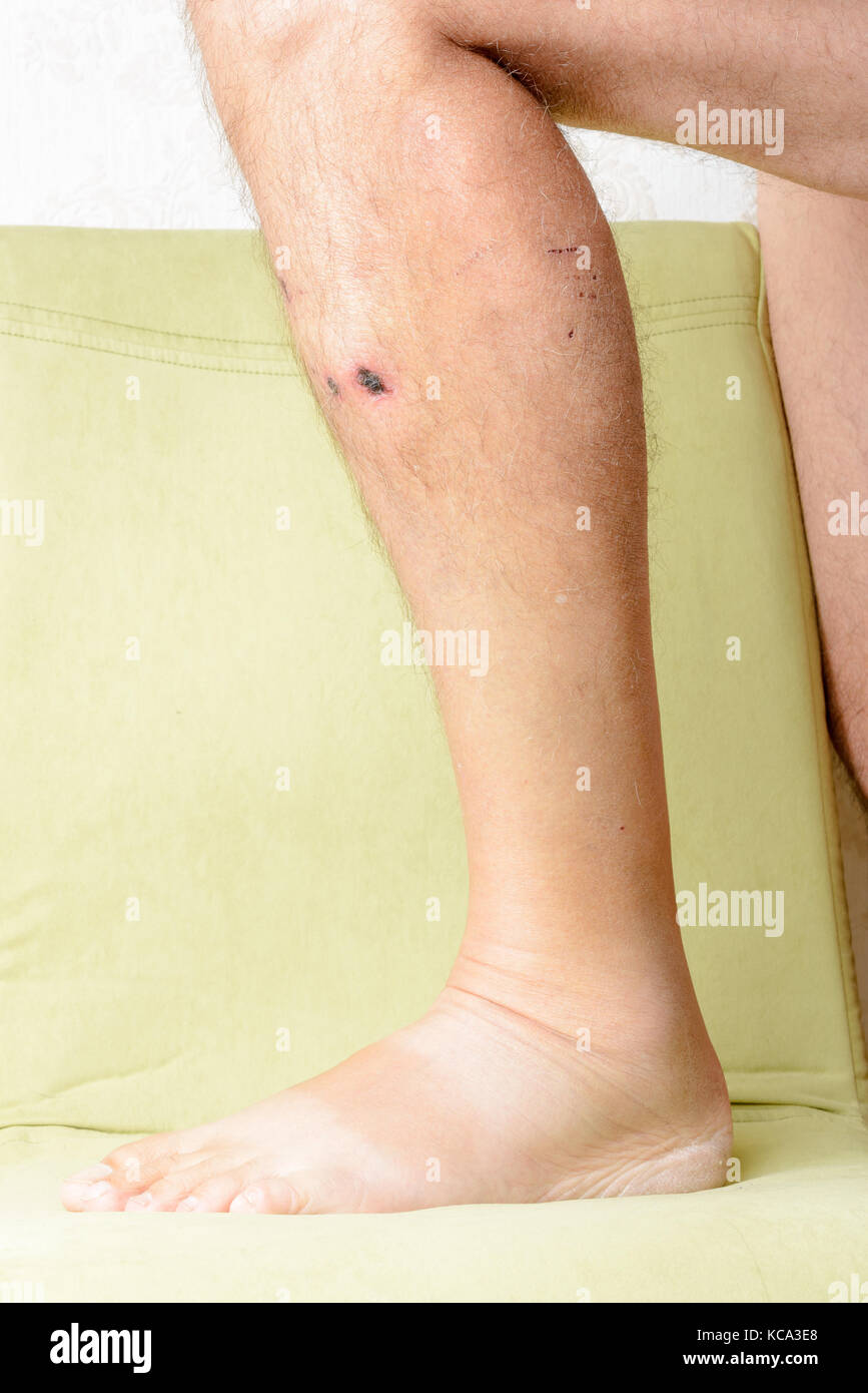 L'uomo ferito dai morsi di cane nella gamba. le profonde ferite lasciate dalle zanne sono evidenti. Foto Stock