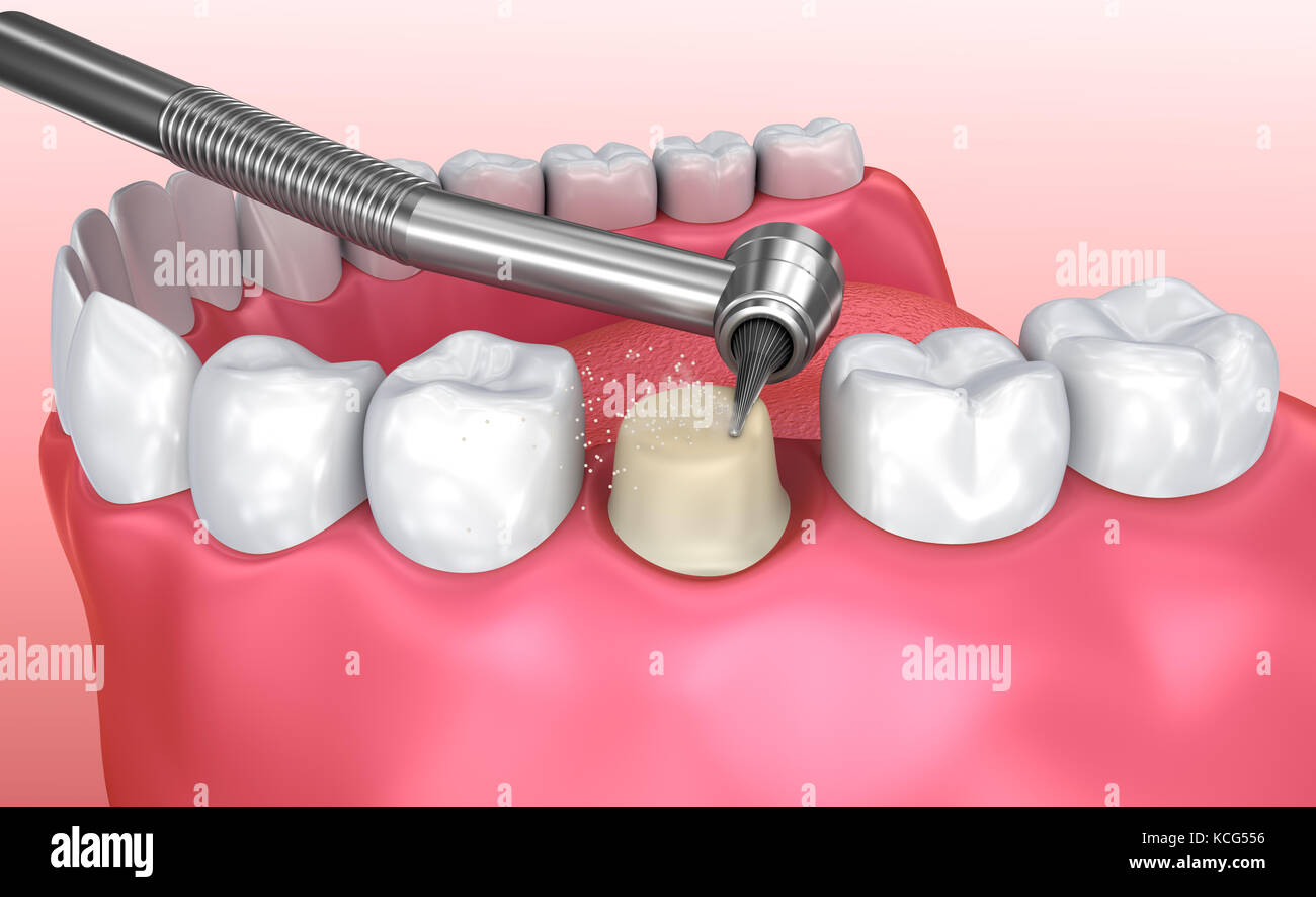 Processo di installazione della corona dentale, illustrazione 3d accurata dal punto di vista medico Foto Stock